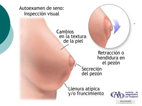 Cáncer de mama:un enfoque preventivo y diagnostico temprano Cáncer de mama:un enfoque preventivo y diagnostico temprano