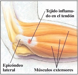 Tratamiento para la
epicondilitis o codo de tenista Tratamiento para la
epicondilitis o codo de tenista